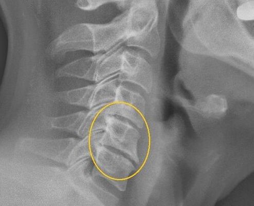 عظمية العظم من العمود الفقري العنقي على X -Ray
